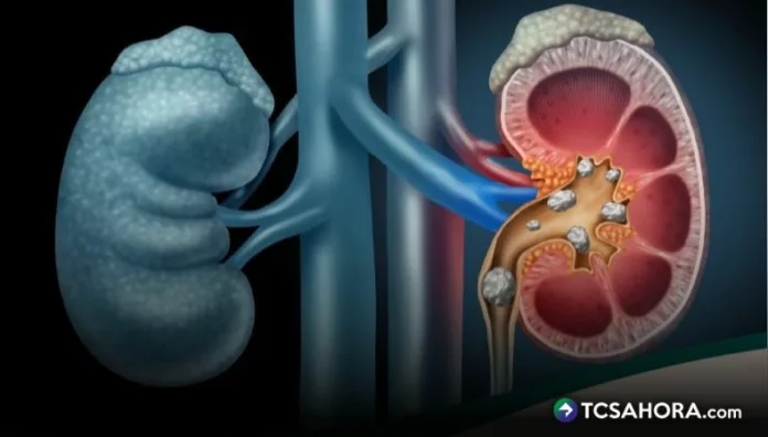 La alta frecuencia de cálculos en los riñones se da mucho más en temporada de calor: incrementa por la deshidratación del cuerpo.