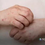 Aumentan casos importados de sarampión en el país