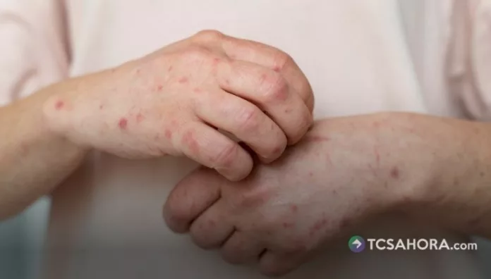 De acuerdo con los médicos, el problema está en las personas que tienen el esquema de vacunación incompleto de sarampión.
