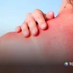 Estos daños pueden provocar en la piel la exposición al sol