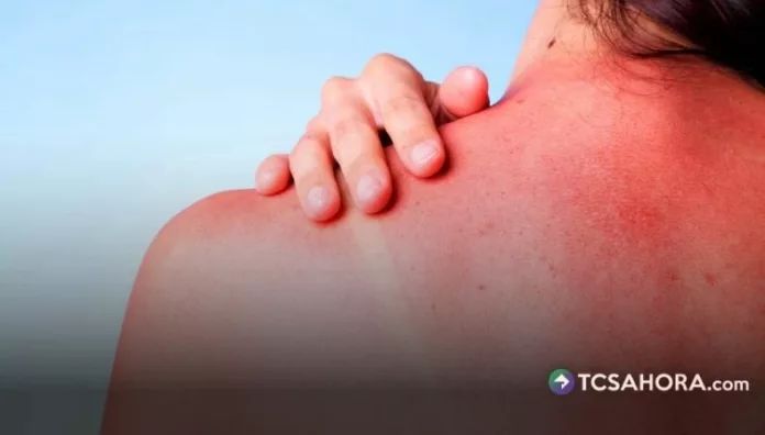 La protección debe mantenerse como un hábito diario para reducir quemaduras y efectos que la radiación ultravioleta puede generar en la piel.