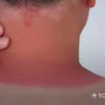 ¿Irritación o quemadura solar? Estas son las diferencias