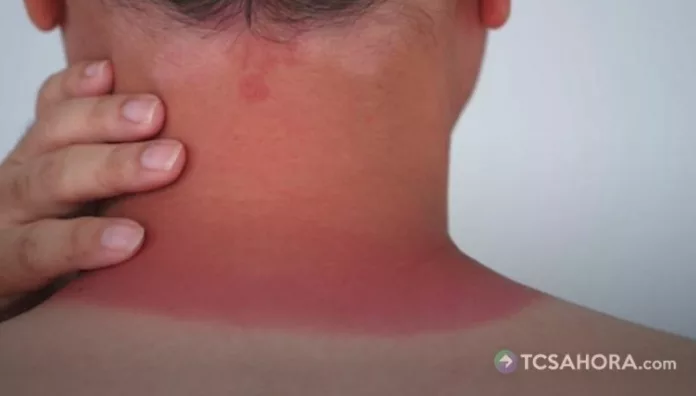 La quemadura solar puede manifestarse mediante cambios en la coloración de la piel, sensación de calor, sensibilidad, dolor e inflamación.